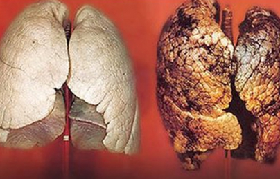Nấm lim xanh Quảng Nam điều trị bệnh ung thư phổi