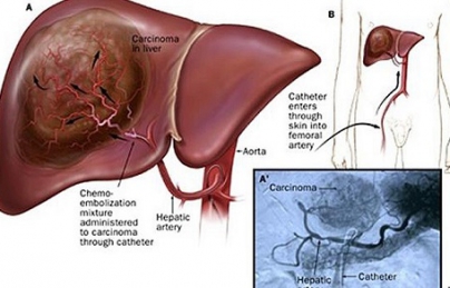Chữa bệnh ung thư gan giai đoạn cuối. Bài thuốc Nam trị K gan Chữa bệnh ung thư gan giai đoạn cuối. Bài thuốc Nam trị K gan