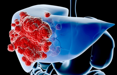 Bài thuốc nam chữa ung thư gan kỳ diệu Bài thuốc nam chữa ung thư gan kỳ diệu